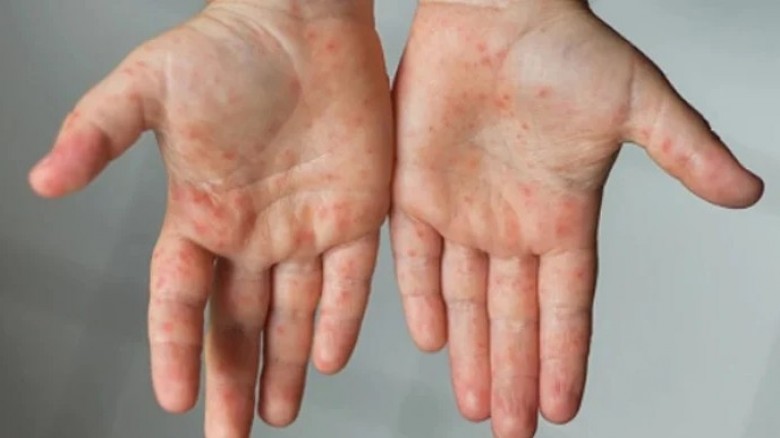 ২৪ ঘণ্টায় হাম ও হামের উপসর্গে আরও ৫ শিশুর মৃত্যু, আক্রান্ত ১২৭৮