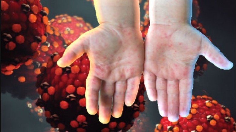 হামে ২১৭ প্রাণহানি! আক্রান্ত ছাড়াল ২৩ হাজার,ঝুঁকিতে শিশুরা।